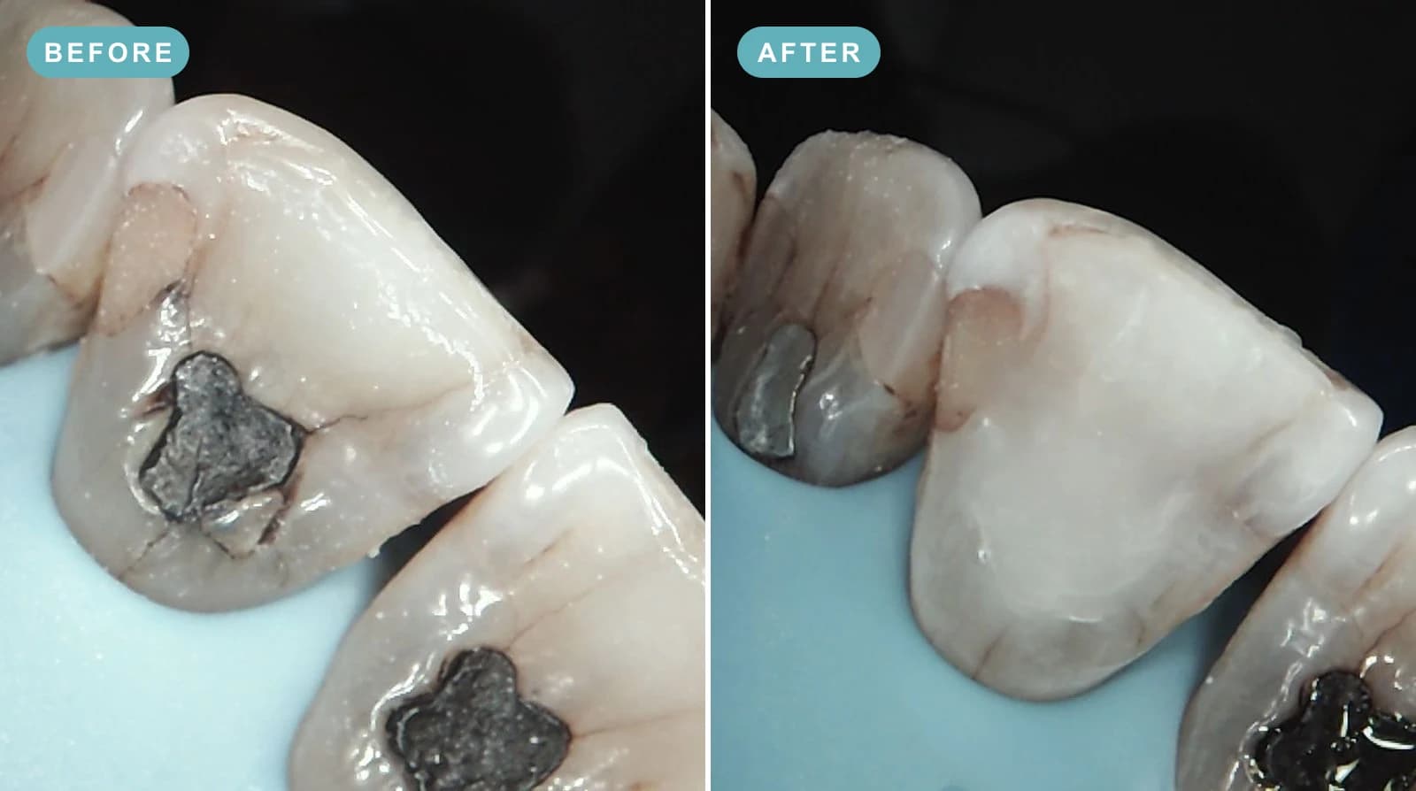 A real before and after of a cracked tooth behind an old amalgam filling, with the cracks sealed and the tooth bonded back to strength